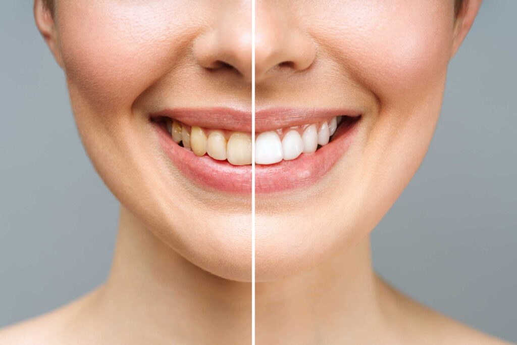 estética dental en Cartagena, Murcia; odontología estética en Cartagena, Murcia.
