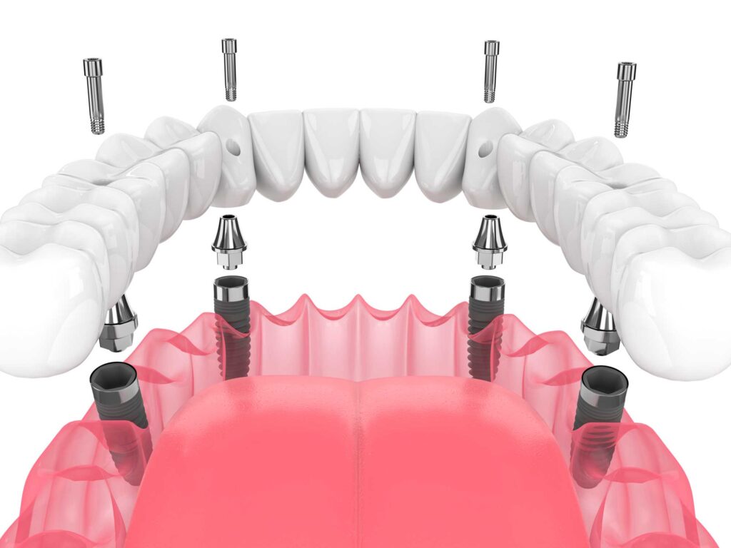 implantes dentales en Cartagena, Murcia; implantología oral en Cartagena, Murcia.
