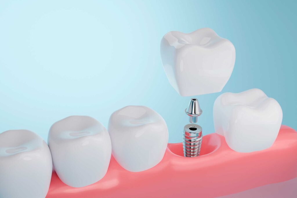 implantes dentales en Cartagena, Murcia; implantología oral en Cartagena, Murcia.