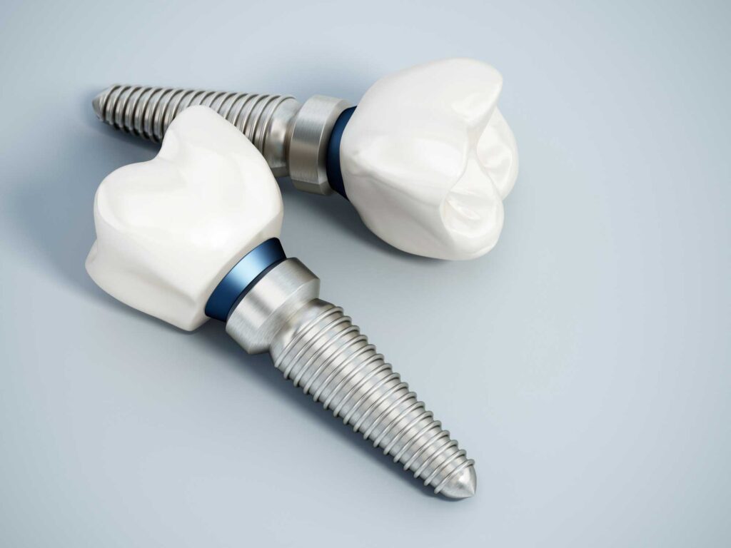 implantes dentales en Cartagena, Murcia; implantología oral en Cartagena, Murcia.