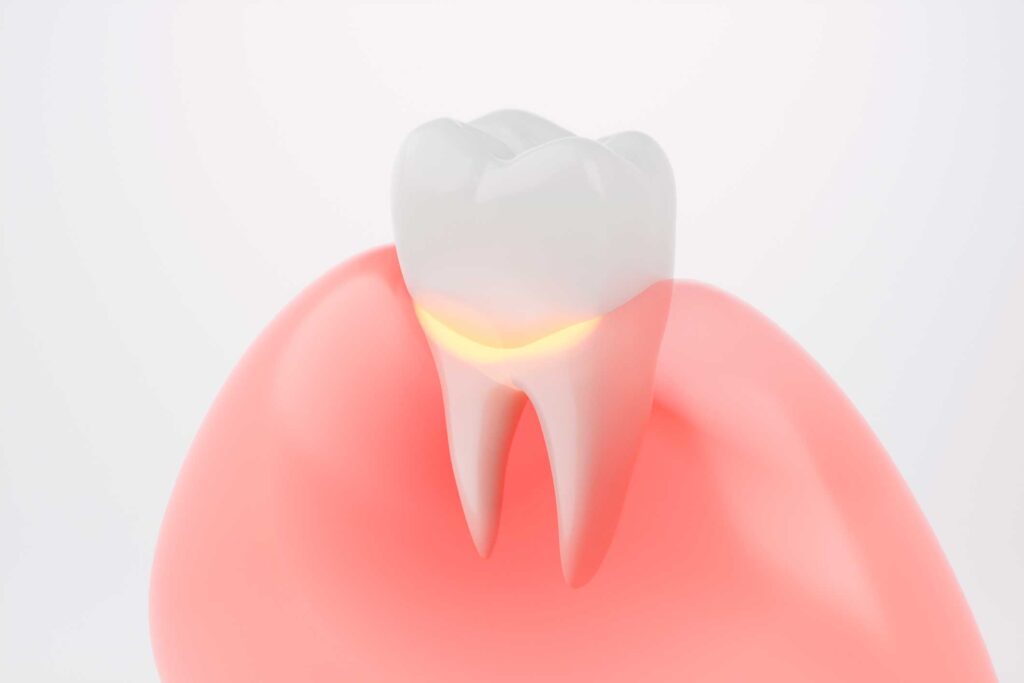 implantes dentales en Cartagena, Murcia; implantología oral en Cartagena, Murcia.