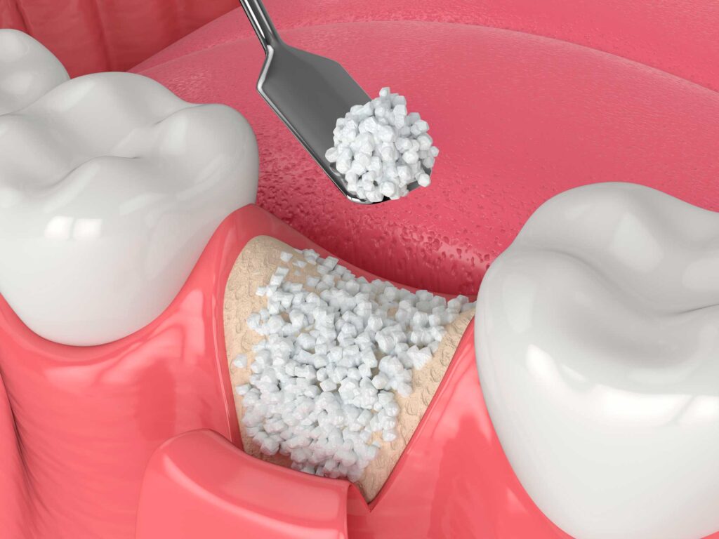 implantes dentales en Cartagena, Murcia; implantología oral en Cartagena, Murcia.